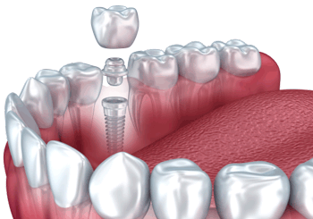 ایمپلنت دندان قسطی