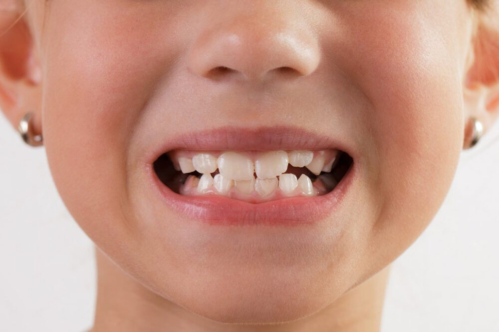 دندان های شیری راهنمای رویش صحیح دندان دائمی هستند | یک متخصص