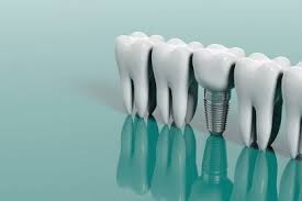 ایمپلنت جایگزینی با طول عمر بالا برای دندان های از دست رفته