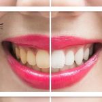 ۵ عادت غلطی که دندانتان را زرد می کند