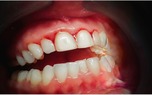 علت ورم لثه ها چیست؟ | ناحیه بافتی که دندان های ما را احاطه